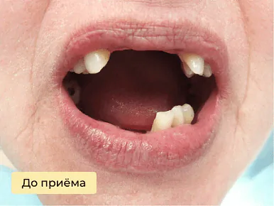 Имплантация — до лечения