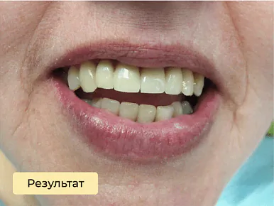 Имплантация — после лечения