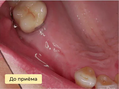 Имплантация — до лечения