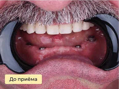 Имплантация — до лечения