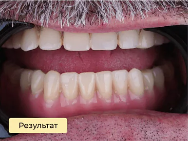 Имплантация — после лечения